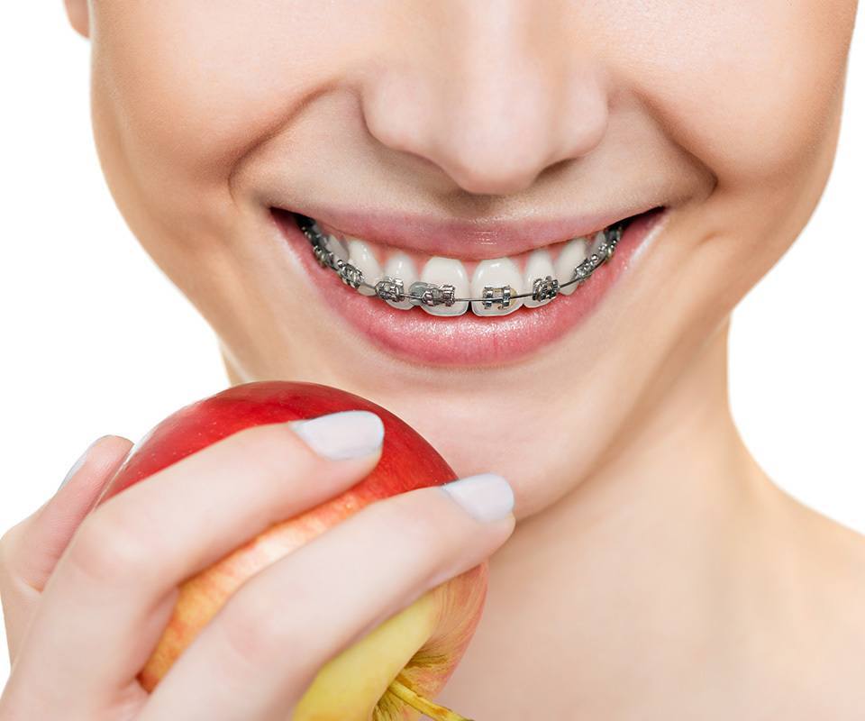 Dental Braces and Orthodontics in North York