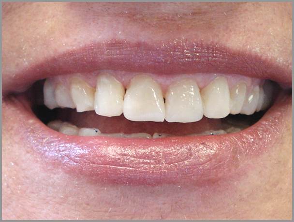 Worn Teeth Bruxism After