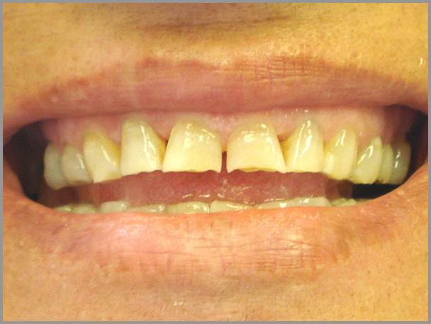 Worn Teeth Bruxism Before