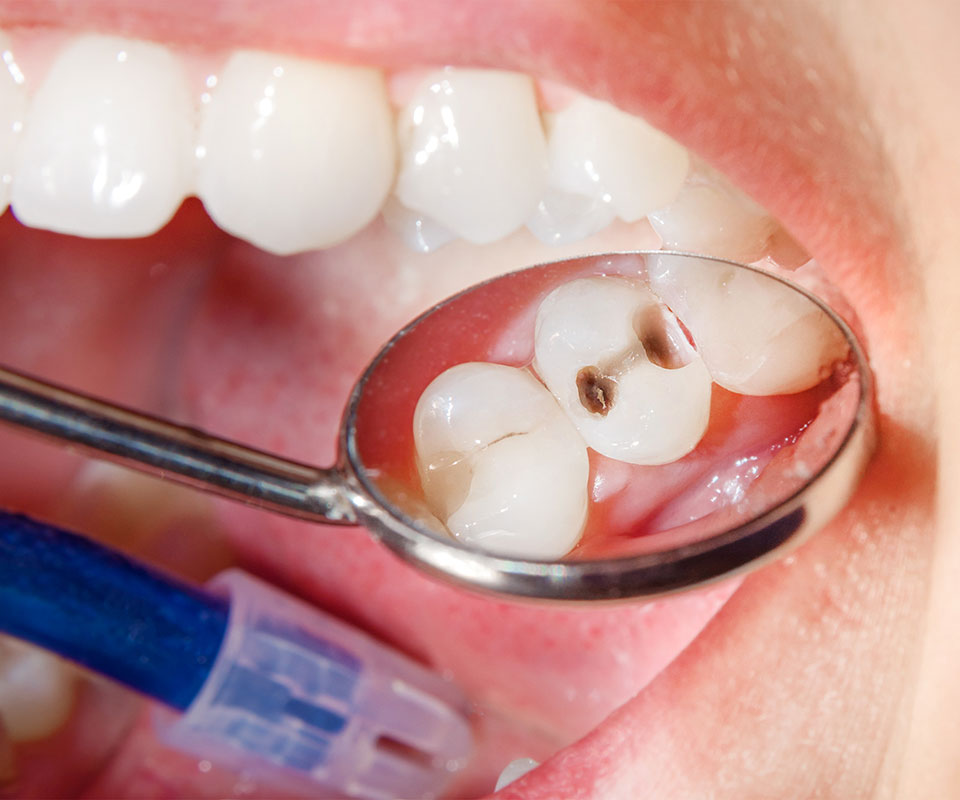 Composite Fillings 1