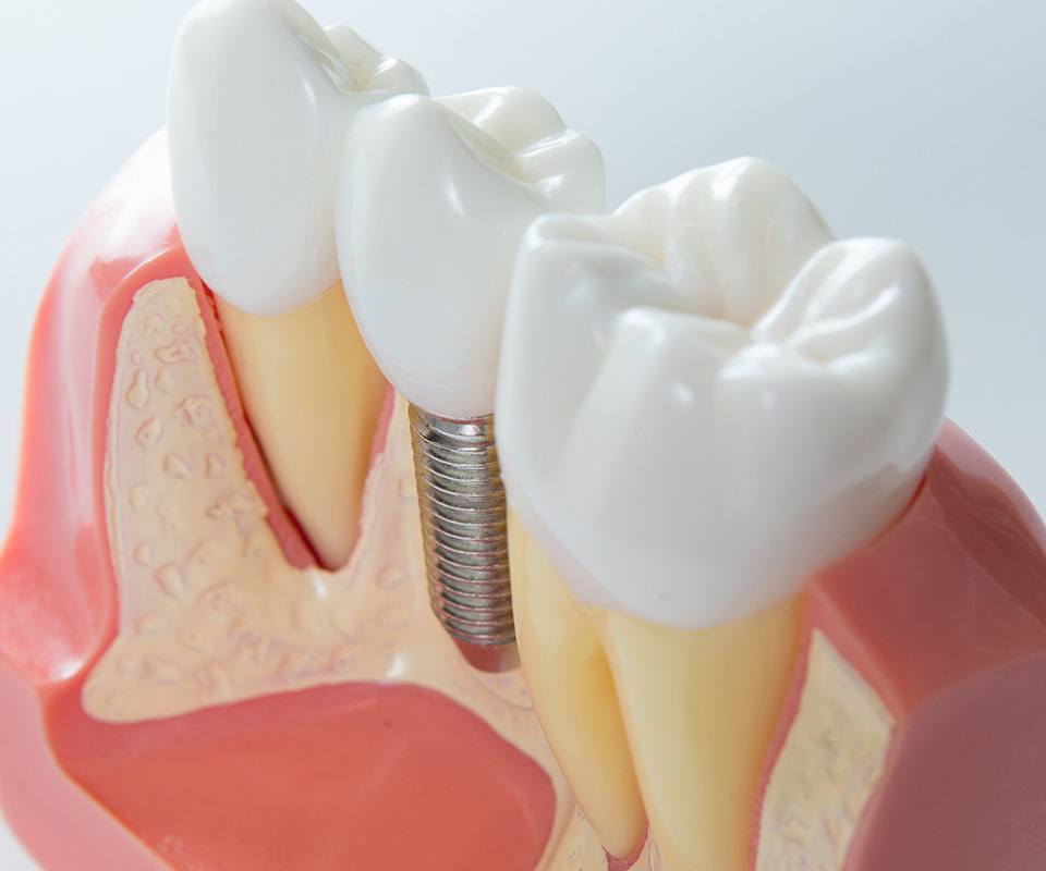 Dental Bridges in North York