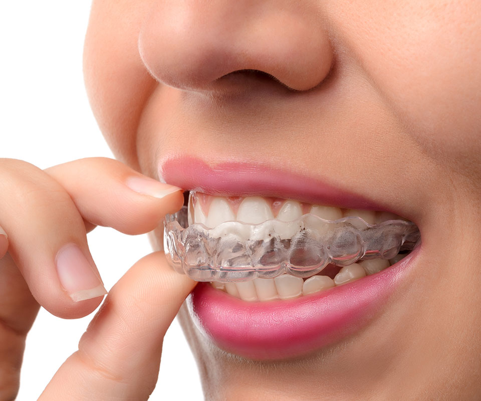 Invisalign Aligners North York