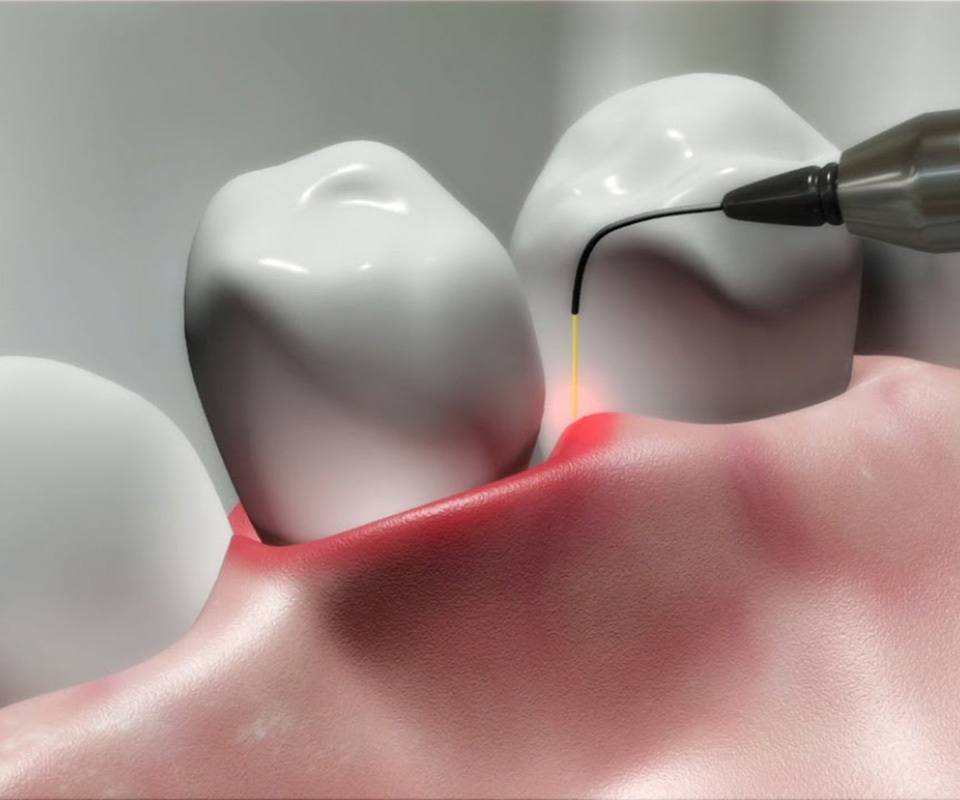 Laser Gum Disease Treatment in Toronto