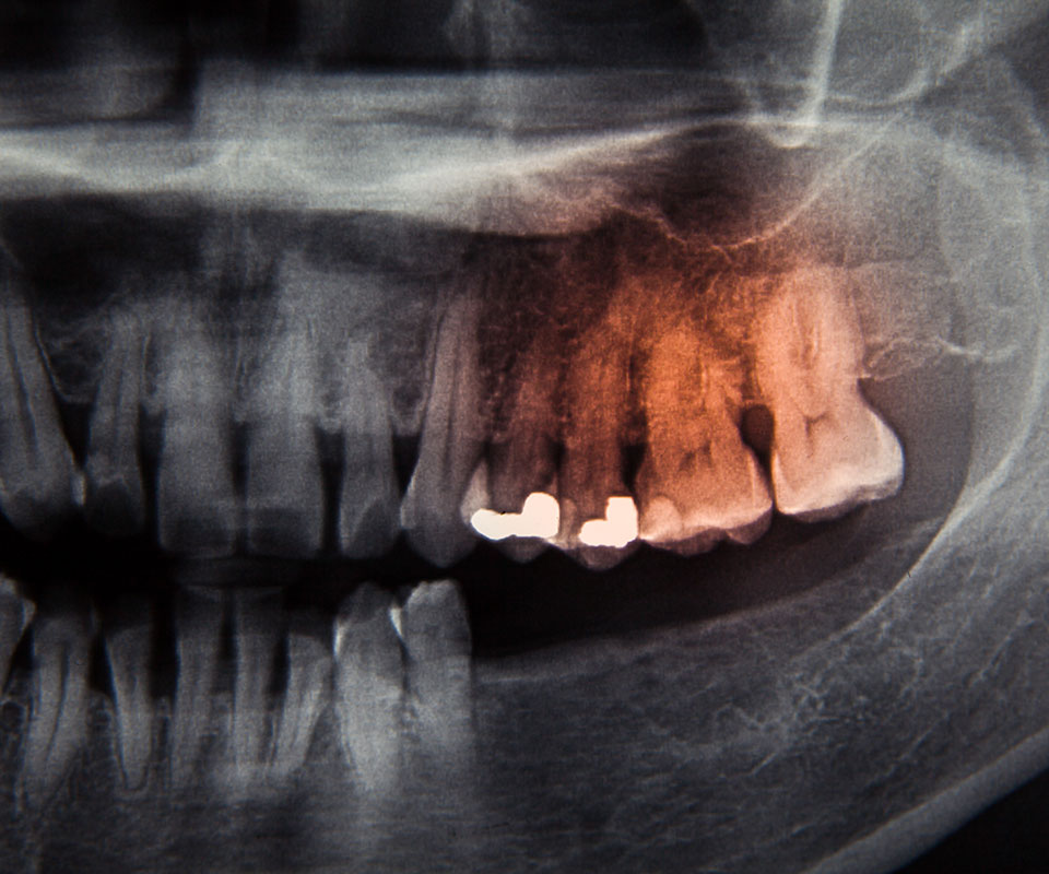 Oral Cancer Screening 1