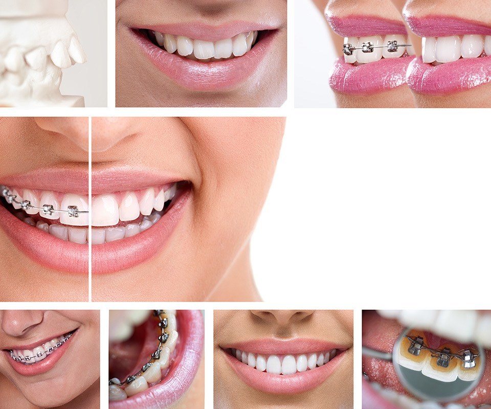 Orthodontic Appliances in North York