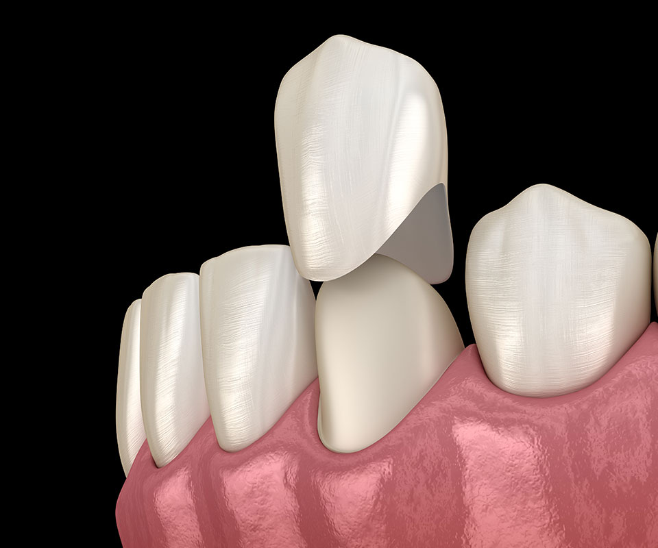 Porcelain Crowns 1