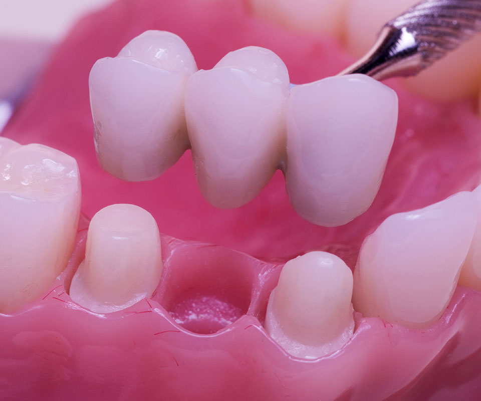 Dental Bridges in North York