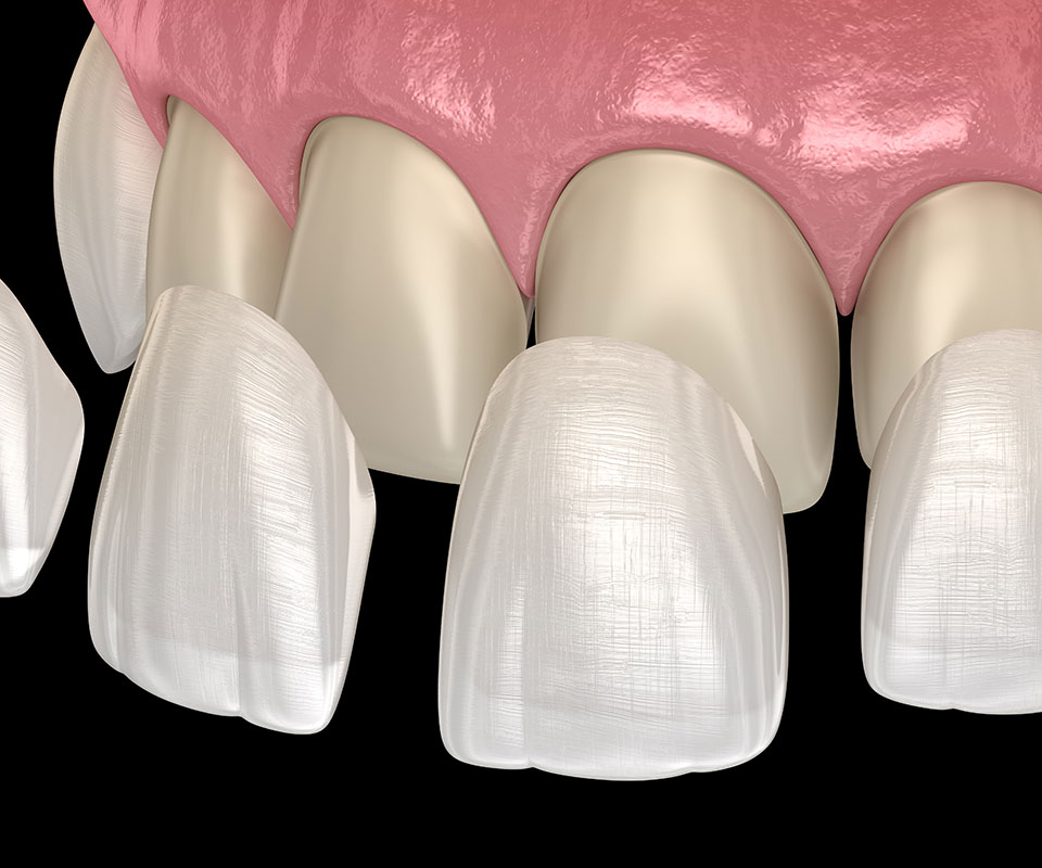 Porcelain Veneers in North York